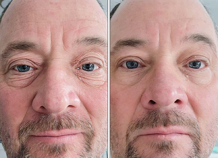 Two close-up photos of a man's face showing before and after effects.