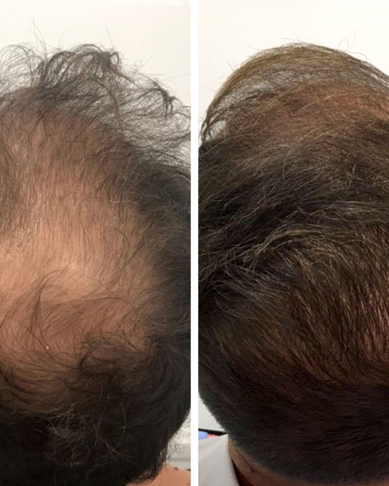 Two images of a scalp before and after hair restoration.