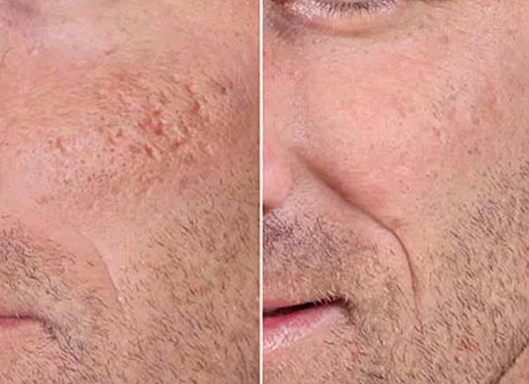 Side-by-side comparison showing a man's cheek before and after Particle Scar Gel treatment.