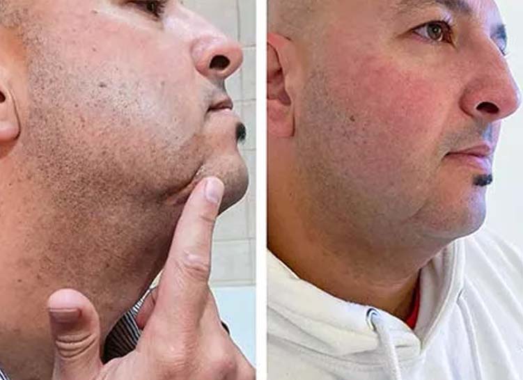 Two photos of a man’s face before and after scar treatment.