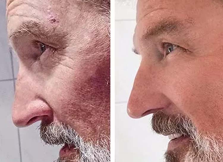 Side-by-side comparison of a man's face before and after skin treatment, showing reduced blemishes and smoother skin texture on the right.