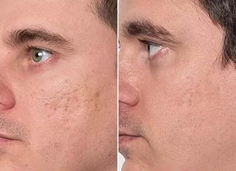 Close-up of a man's face showing scars on the left and smooth skin on the right.