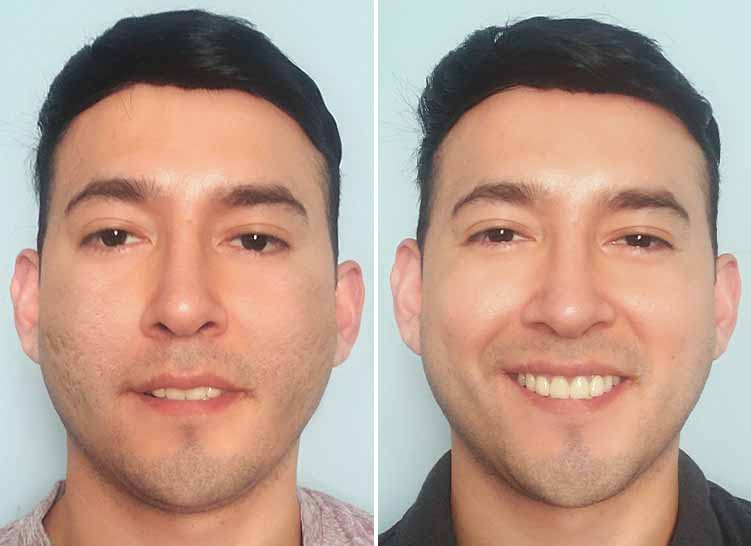 Two close-up images of a man’s face, before and after treatment with Particle Scar Gel.