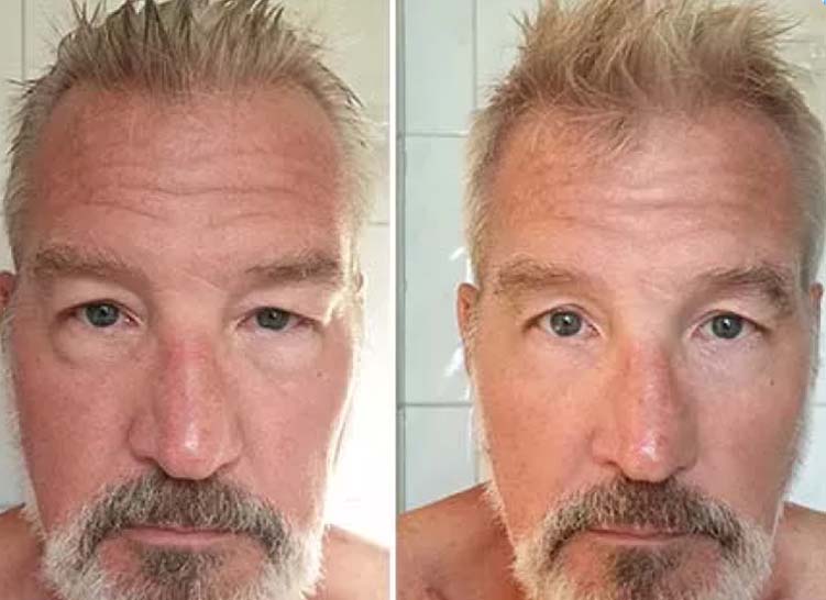 Before-and-after comparison of a middle-aged man’s skin with light hair and beard.