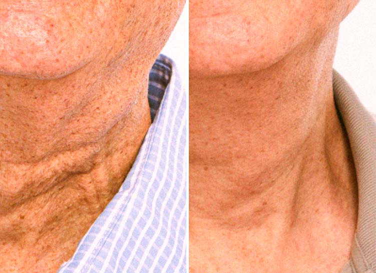 Comparing the neck skin of a man before and after applying a cream to illustrate the difference.