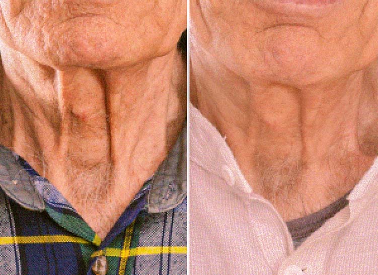 A comparison of two necks, one with more wrinkles and the other with fewer wrinkles.