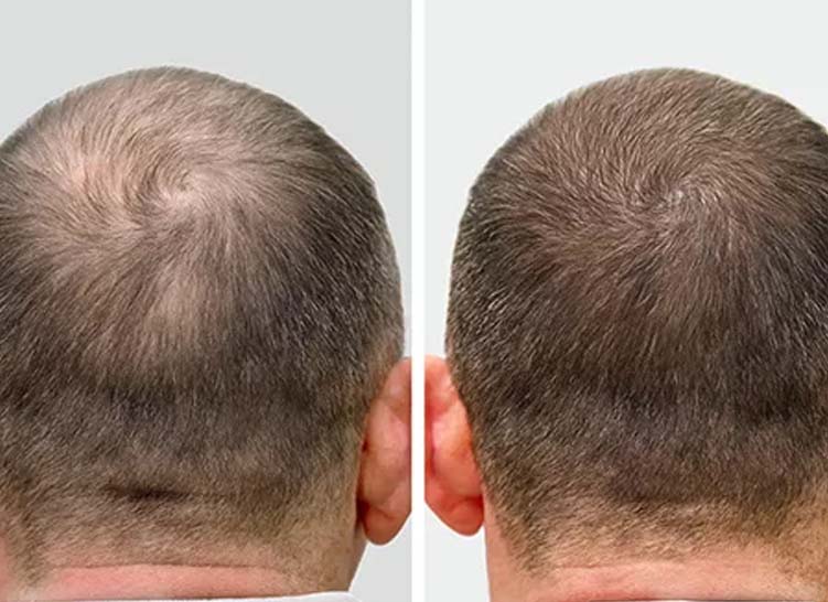 Two heads' backs showing hair loss before and after treatment.