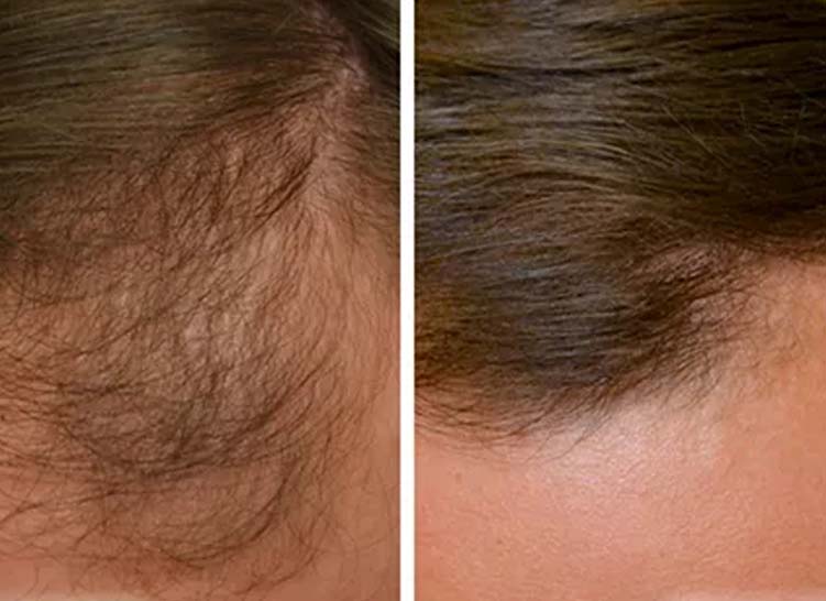 Side-by-side comparison of scalp with thin hair and fuller hair.