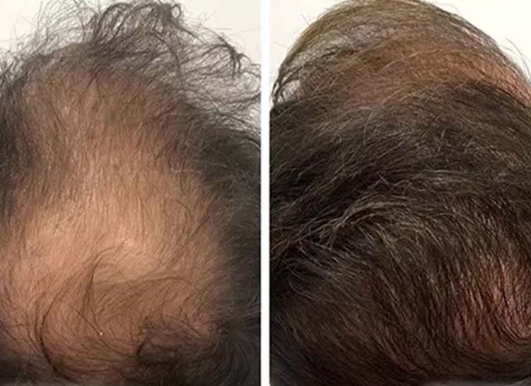 Two images depict the top of a person's head, illustrating noticeable hair regrowth from sparse to thicker hair.