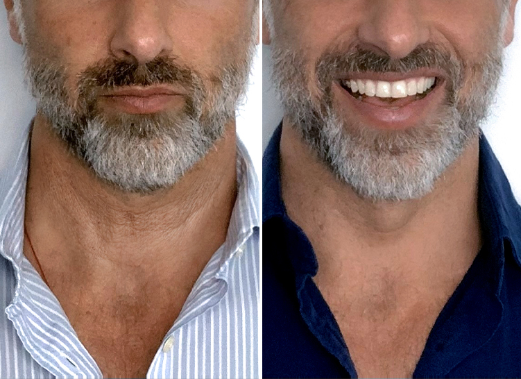 Two photos of elderly man's neck before and after using a cream.