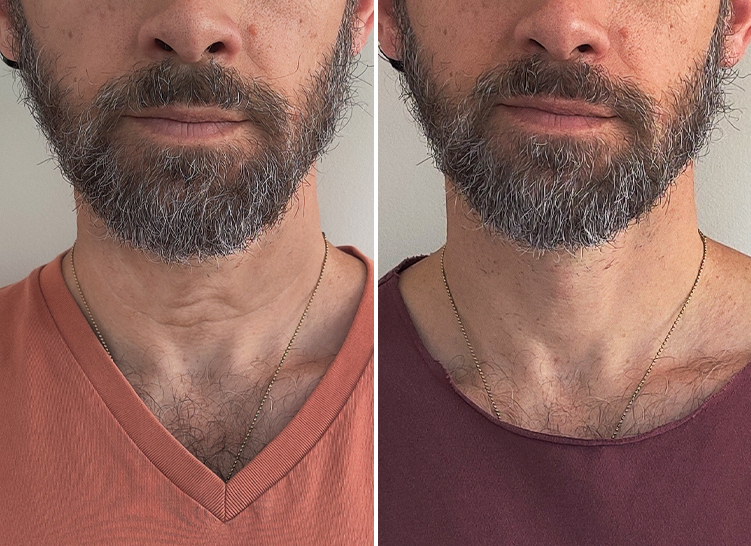 Neck skin of a man with beard comparison illustrating the difference before and after applying a cream.