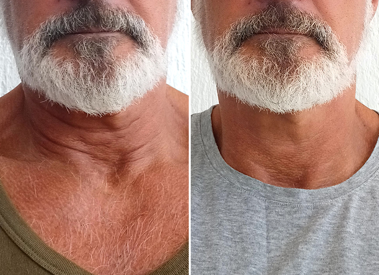 Comparison of an elderly man's neck before and after using a cream.