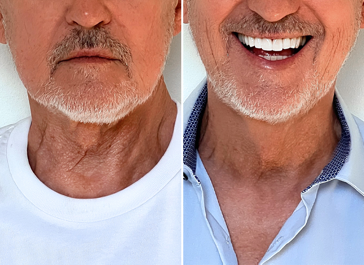 Contrasting the neck skin of an elderly man, illustrating the difference before and after applying a cream.